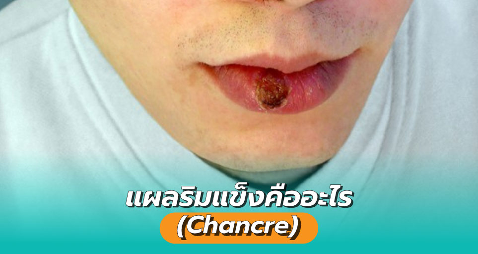 แผลริมแข็ง (Chancre) คืออะไร – Chulalak Pharmacy
