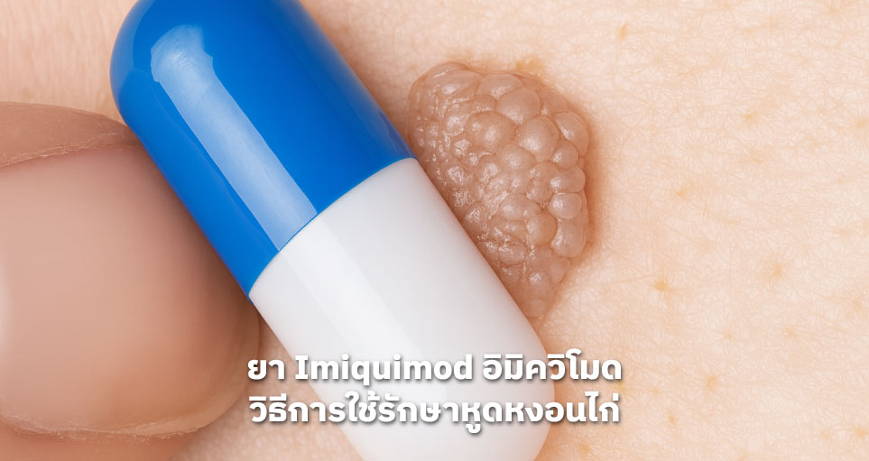 ยา Imiquimod (อิมิควิโมด) วิธีการใช้รักษาหูดหงอนไก่