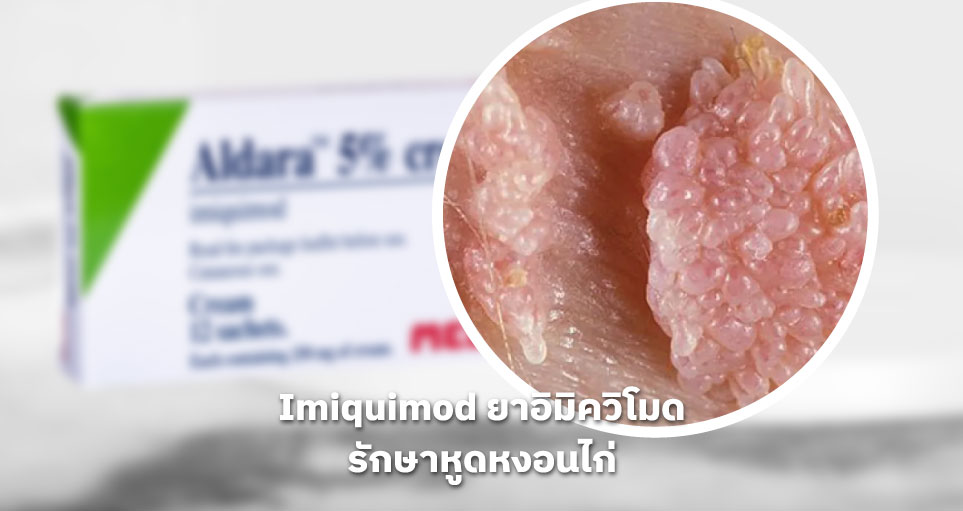 ยา Imiquimod (อิมิควิโมด) วิธีการใช้รักษาหูดหงอนไก่