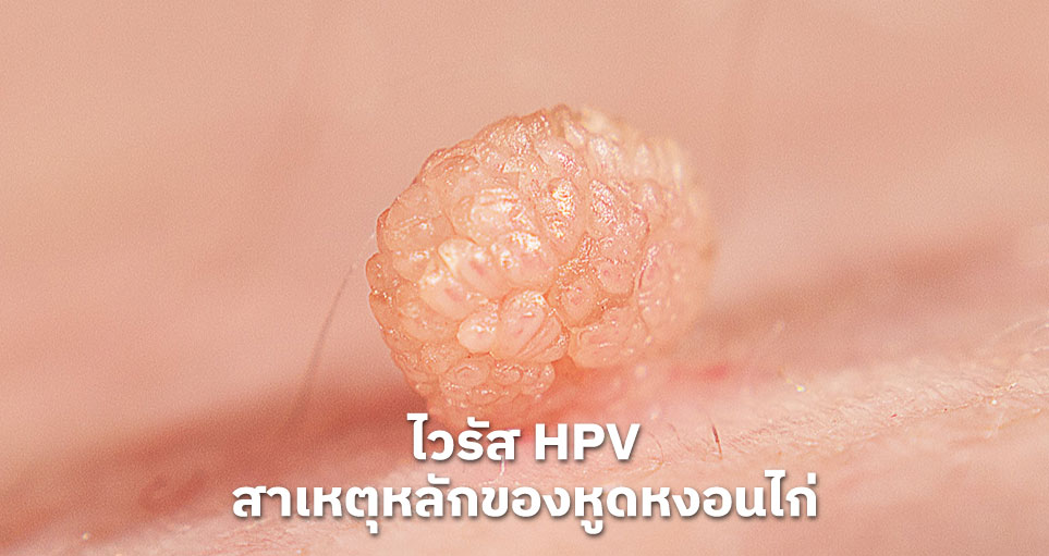 ไวรัส HPV: สาเหตุหลักของหูดหงอนไก่