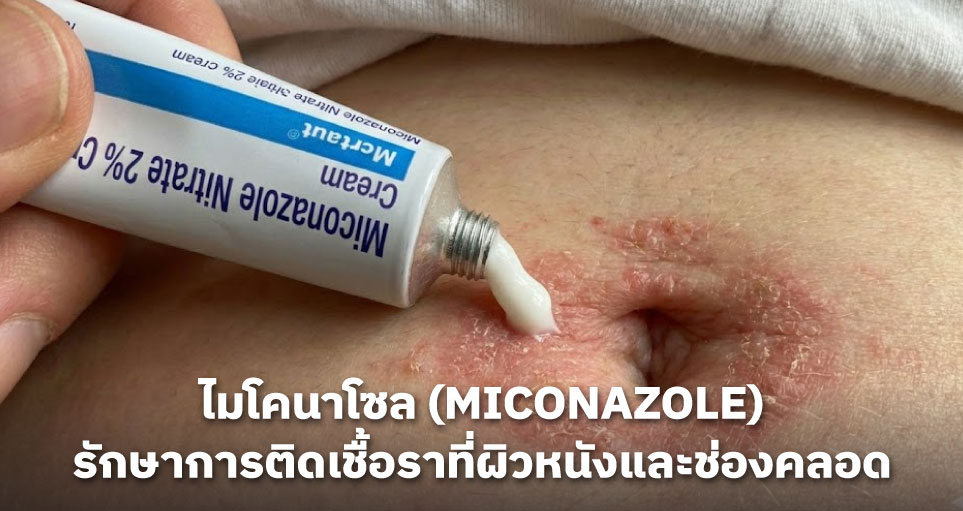 ไมโคนาโซล (Miconazole): ยาต้านเชื้อราที่ใช้รักษาการติดเชื้อที่ผิวหนังและช่องคลอด