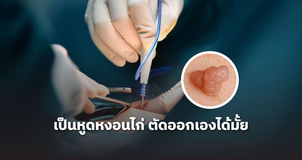 เป็นหูดหงอนไก่ ตัดออกเองได้มั้ย: อันตรายจากการตัดเอง วิธีรักษา HPV และการป้องกัน
