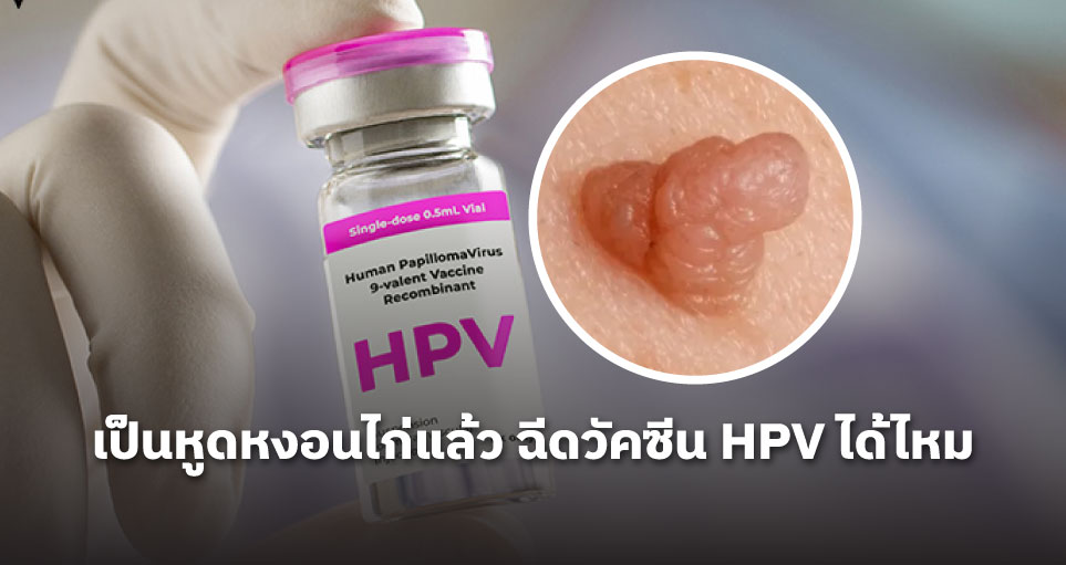 เป็นหูดหงอนไก่แล้ว ฉีดวัคซีน HPV ได้ไหม: ป้องกันการเป็นซ้ำได้หรือไม่ และความจำเป็นในการฉีด