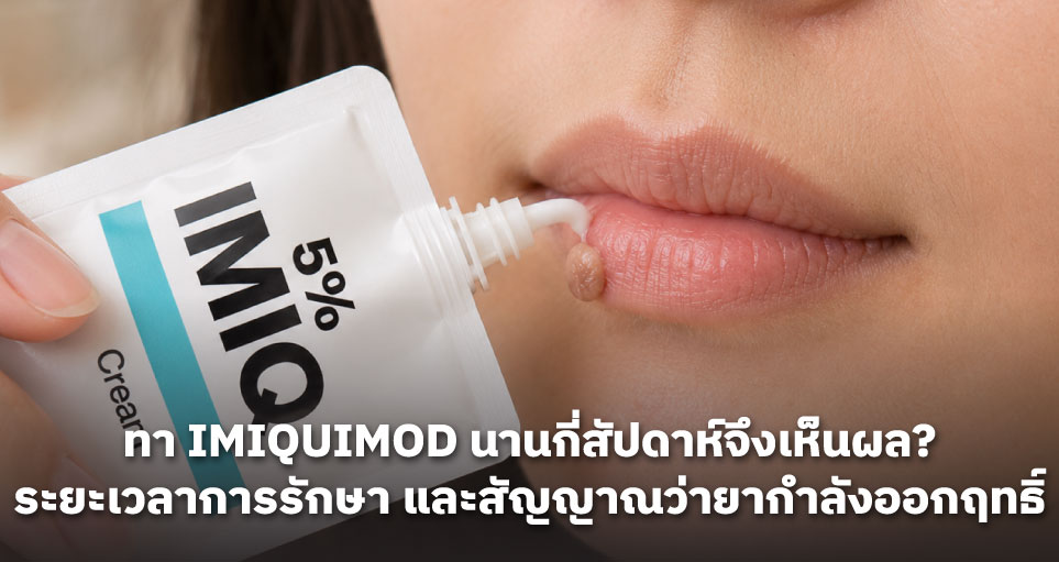 ทา Imiquimod นานกี่สัปดาห์จึงเห็นผล? ระยะเวลาการรักษา และสัญญาณที่บ่งบอกว่ายากำลังออกฤทธิ์