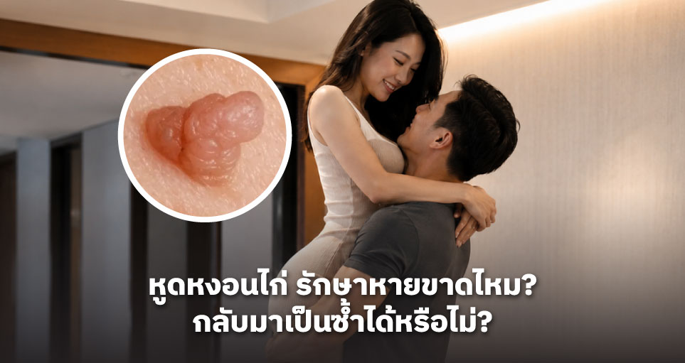 หูดหงอนไก่ รักษาหายขาดไหม? กลับมาเป็นซ้ำได้หรือไม่? ไขทุกข้อสงสัยเกี่ยวกับ HPV และการรักษา