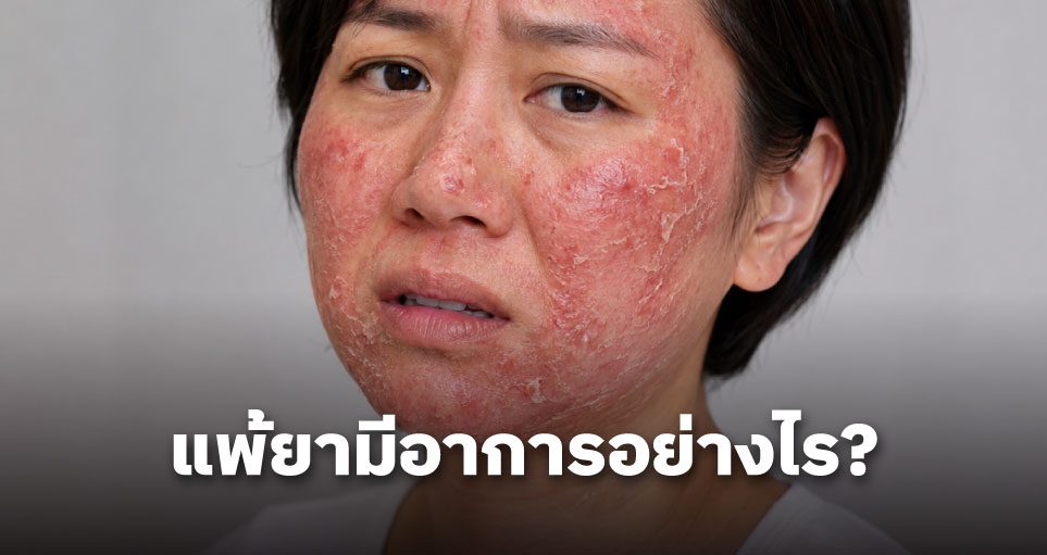 แพ้ยามีอาการอย่างไร? สังเกตอาการแพ้ยา ผื่นแพ้ยา และเมื่อไหร่ควรรีบพบแพทย์