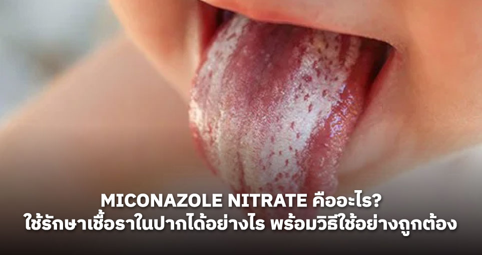 Miconazole Nitrate คืออะไร? ใช้รักษาเชื้อราในปากได้อย่างไร พร้อมวิธีใช้อย่างถูกต้อง