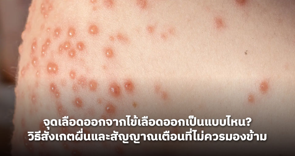 จุดเลือดออกจากไข้เลือดออกเป็นแบบไหน? วิธีสังเกตผื่นและสัญญาณเตือนที่ไม่ควรมองข้าม