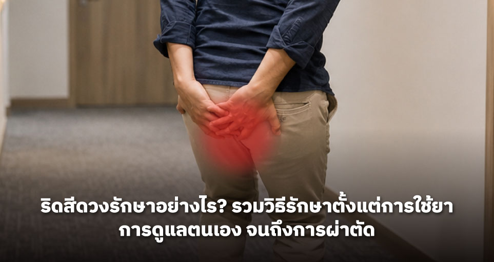 ริดสีดวงรักษาอย่างไร? รวมวิธีรักษาตั้งแต่การใช้ยา การดูแลตนเอง จนถึงการผ่าตัด