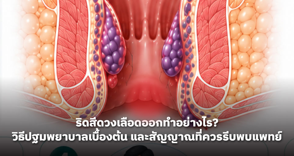 ริดสีดวงเลือดออกทำอย่างไร? วิธีปฐมพยาบาลเบื้องต้น และสัญญาณที่ควรรีบพบแพทย์