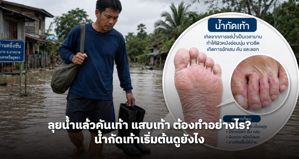 ลุยน้ำแล้วคันเท้า แสบเท้า ต้องทำอย่างไร? น้ำกัดเท้าเริ่มต้นดูยังไง