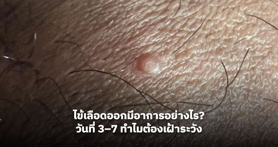 หูดหงอนไก่เริ่มต้นเป็นแบบไหน? ตุ่มแบบไหนควรสงสัย HPV