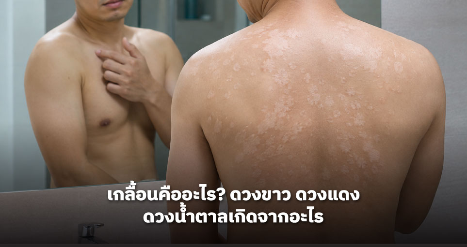 เกลื้อนคืออะไร? ดวงขาว ดวงแดง ดวงน้ำตาลเกิดจากอะไร