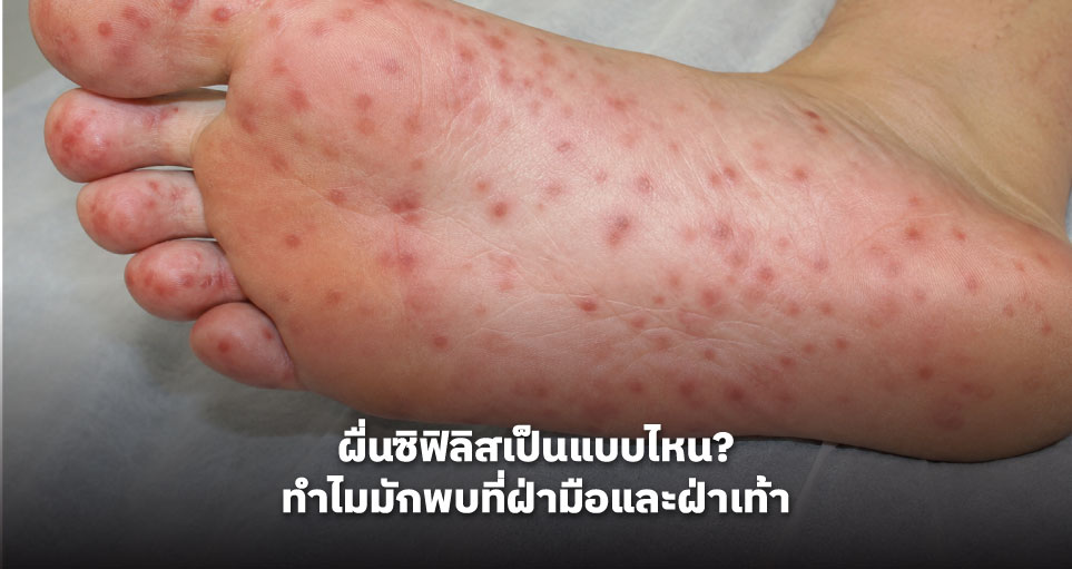 ผื่นซิฟิลิสเป็นแบบไหน? ทำไมมักพบที่ฝ่ามือและฝ่าเท้า