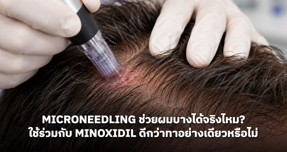 Microneedling ช่วยผมบางได้จริงไหม? ใช้ร่วมกับ Minoxidil ดีกว่าทาอย่างเดียวหรือไม่