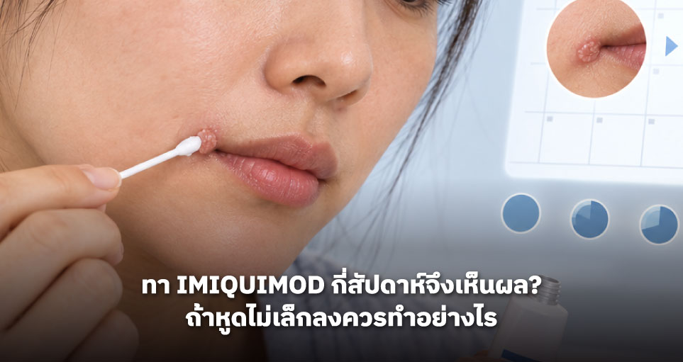 ทา Imiquimod กี่สัปดาห์จึงเห็นผล? ถ้าหูดไม่เล็กลงควรทำอย่างไร
