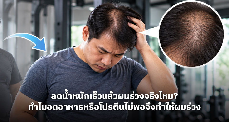 ลดน้ำหนักเร็วแล้วผมร่วงจริงไหม? ทำไมอดอาหารหรือโปรตีนไม่พอจึงทำให้ผมร่วง